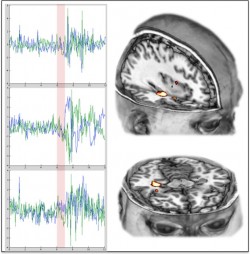 cerebro