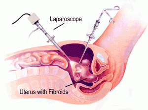 fibroma-uterino-a-tu-salud