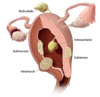 fibromas-uterinos-a-tu-salud
