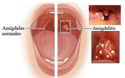 amigdalitis.jpg_796805692