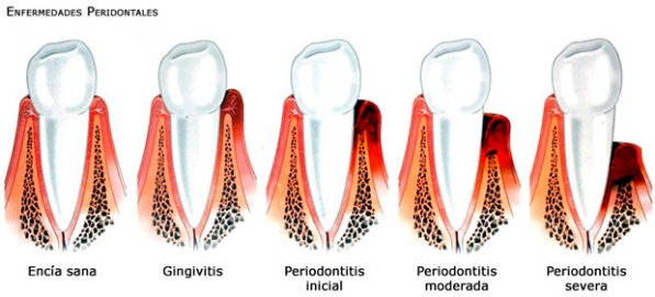 periodontitis.jpg_1805013953