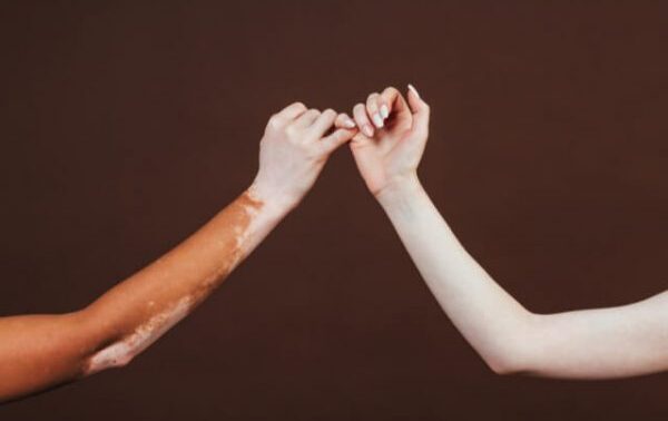 ¿Qué es el melanismo?